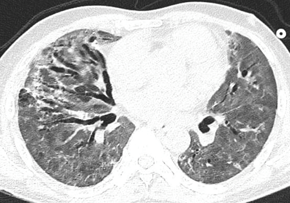 CT-chest-showing-extensive-ground-glass-opacities-in-both-lung-fields-with-progression-of-the-traction-bronchiectasis-particularly-in-the-right-lung