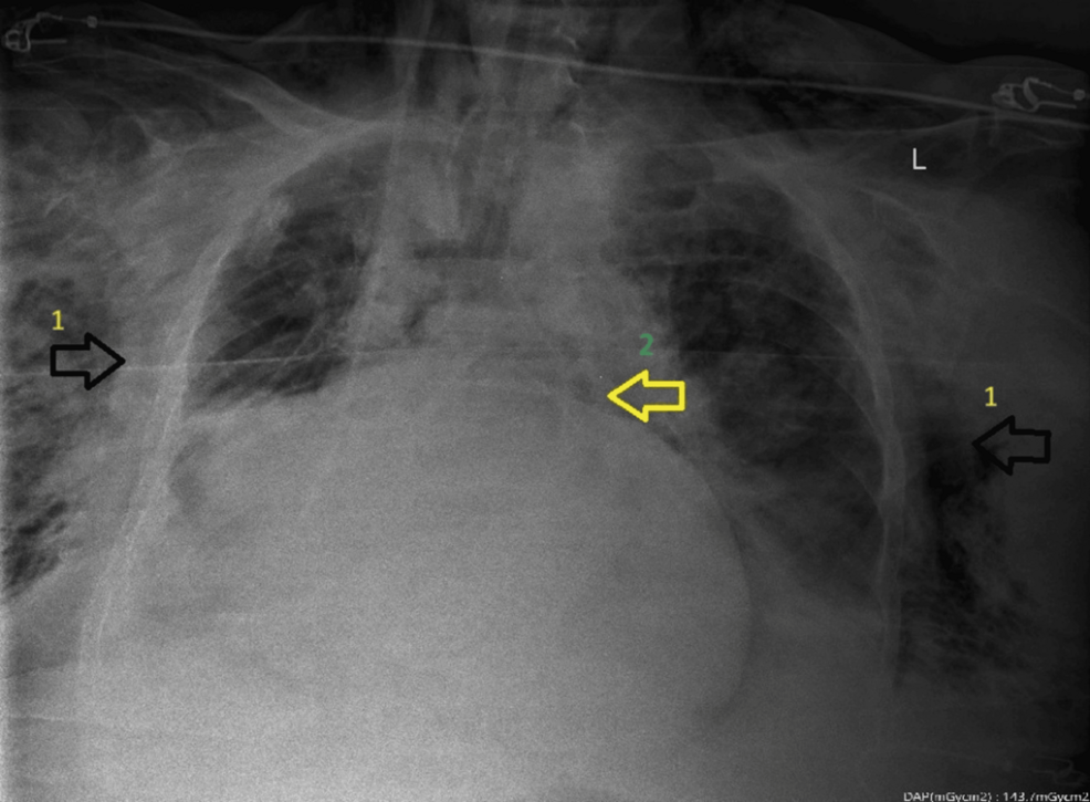 Supine-anteroposterior-chest-radiograph