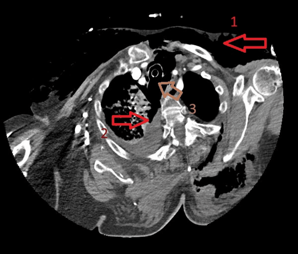 Contrast-enhanced-thoracic-computed-tomography,-axial-section-at-the-level-of-the-thoracic-inlet