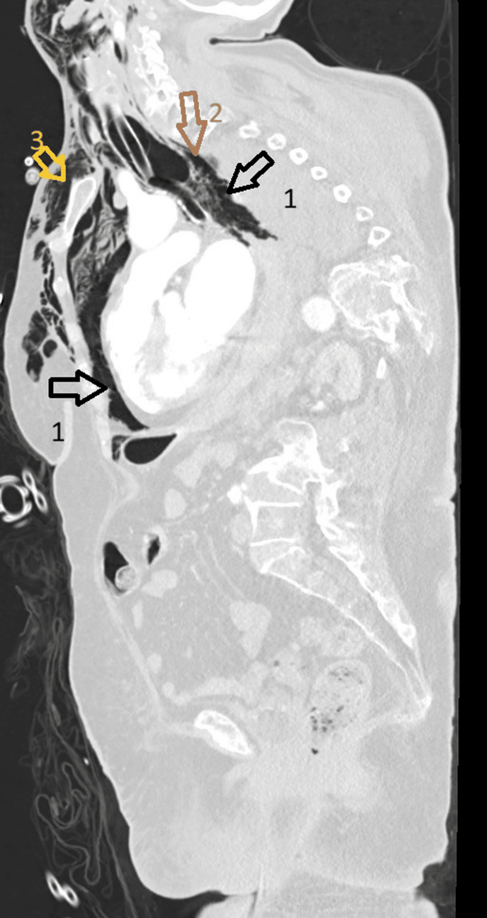 Contrast-enhanced-thoracic-computed-tomography,-sagittal-reformat