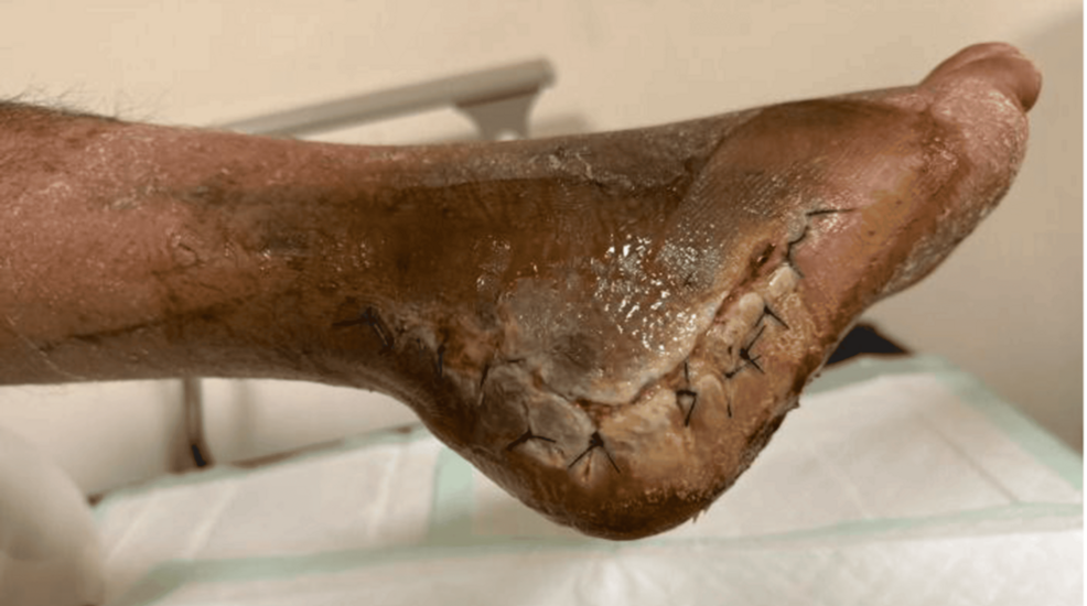 Surgical-site-infection-two-weeks-after-ORIF,-demonstrating-wound-discoloration,-purulent-discharge,-and-foul-odor