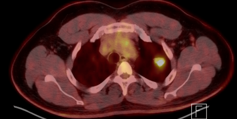 A Case of Typical Carcinoid Tumor of the Lung: A Rare but Aggressive Subtype with Implications for Surveillance and Management