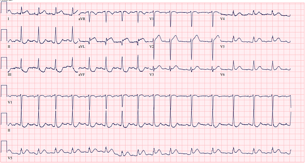 Cureus | ST-Elevation Myocardial Infarction in a 23-Year-Old Female ...