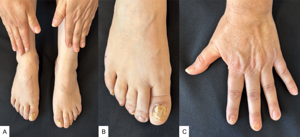 Isolated Nail Lichen Planus With Extensive Involvement: The Importance of Clinicopathologic Correlation and Response to Hydroxychloroquine
