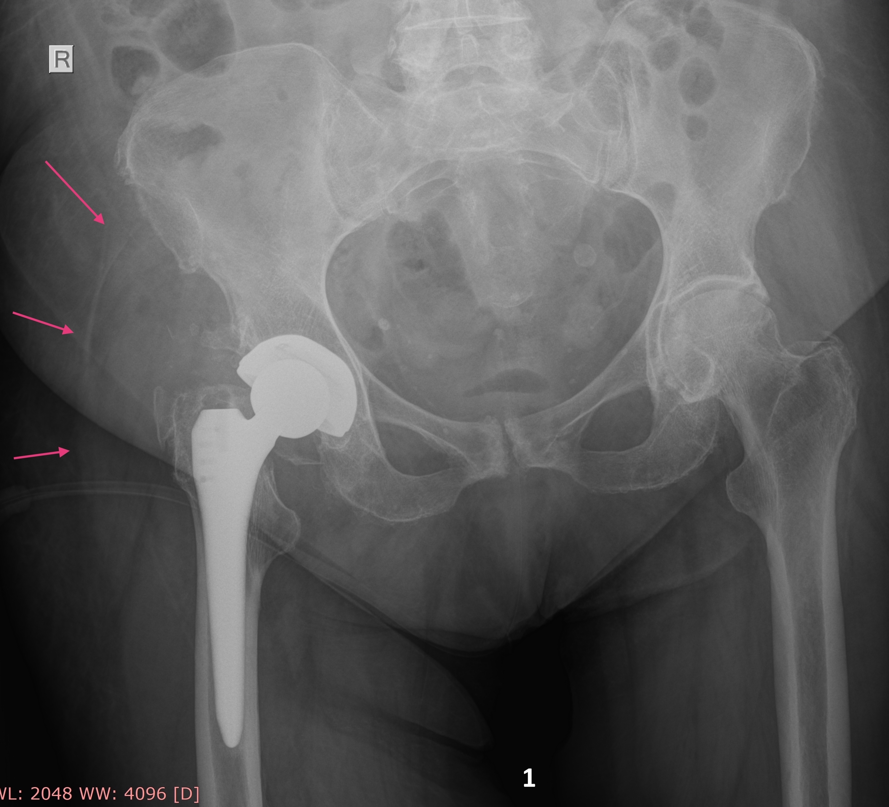 psoas sign x ray