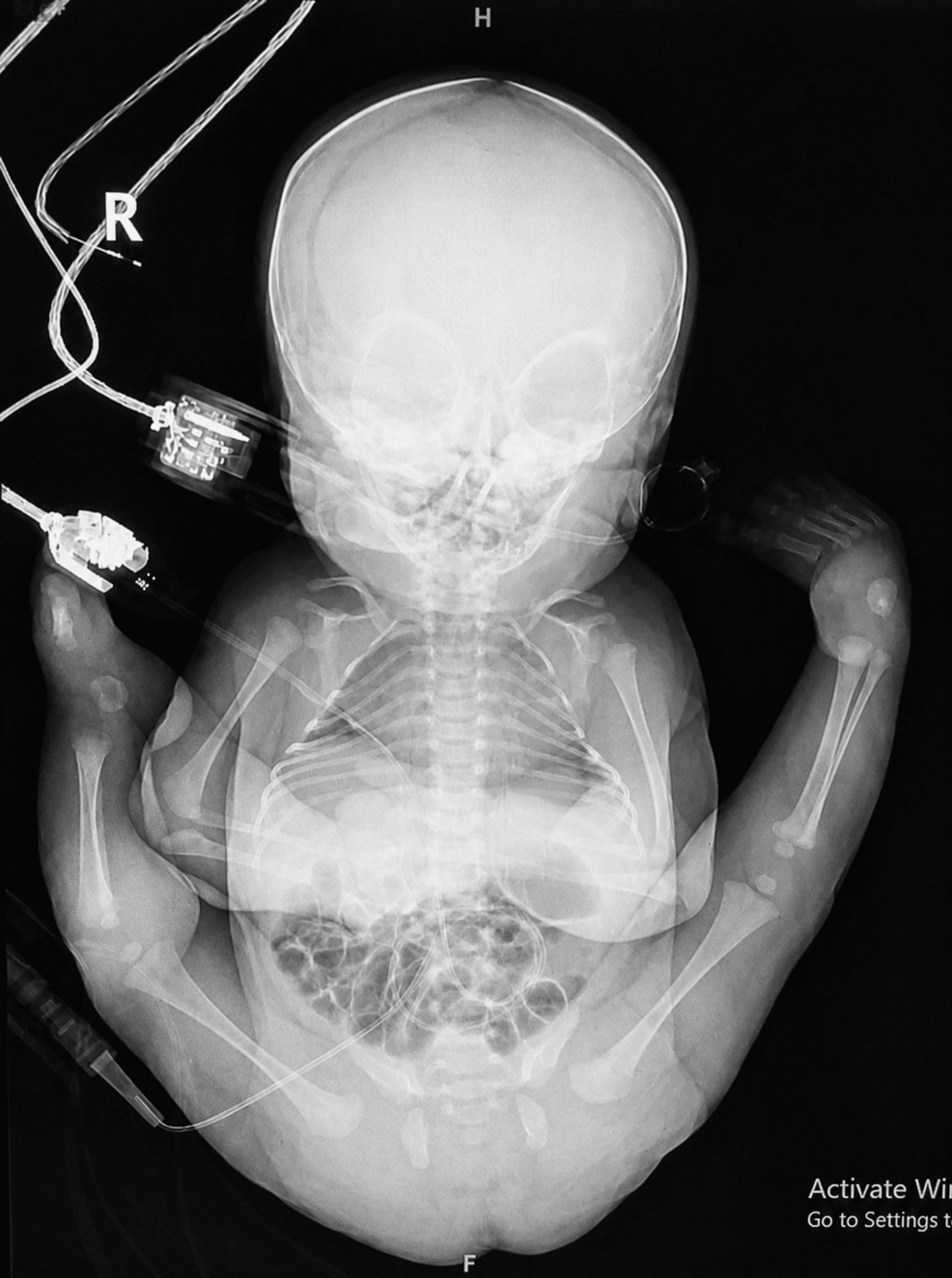 Preoperative-whole-body-anteroposterior-radiograph-of-the-neonate-showing-multiple-congenital-musculoskeletal-deformities-consistent-with-arthrogryposis-multiplex-congenita-(AMC),-including-severe-limb-contractures-and-craniofacial-abnormalities,-indicative-of-a-predicted-difficult-airway.