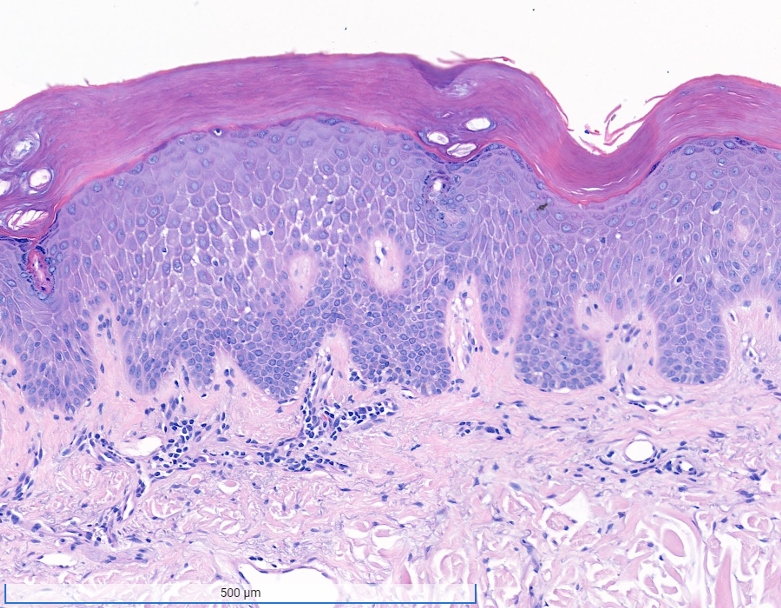 eczematous dermatitis histopathology