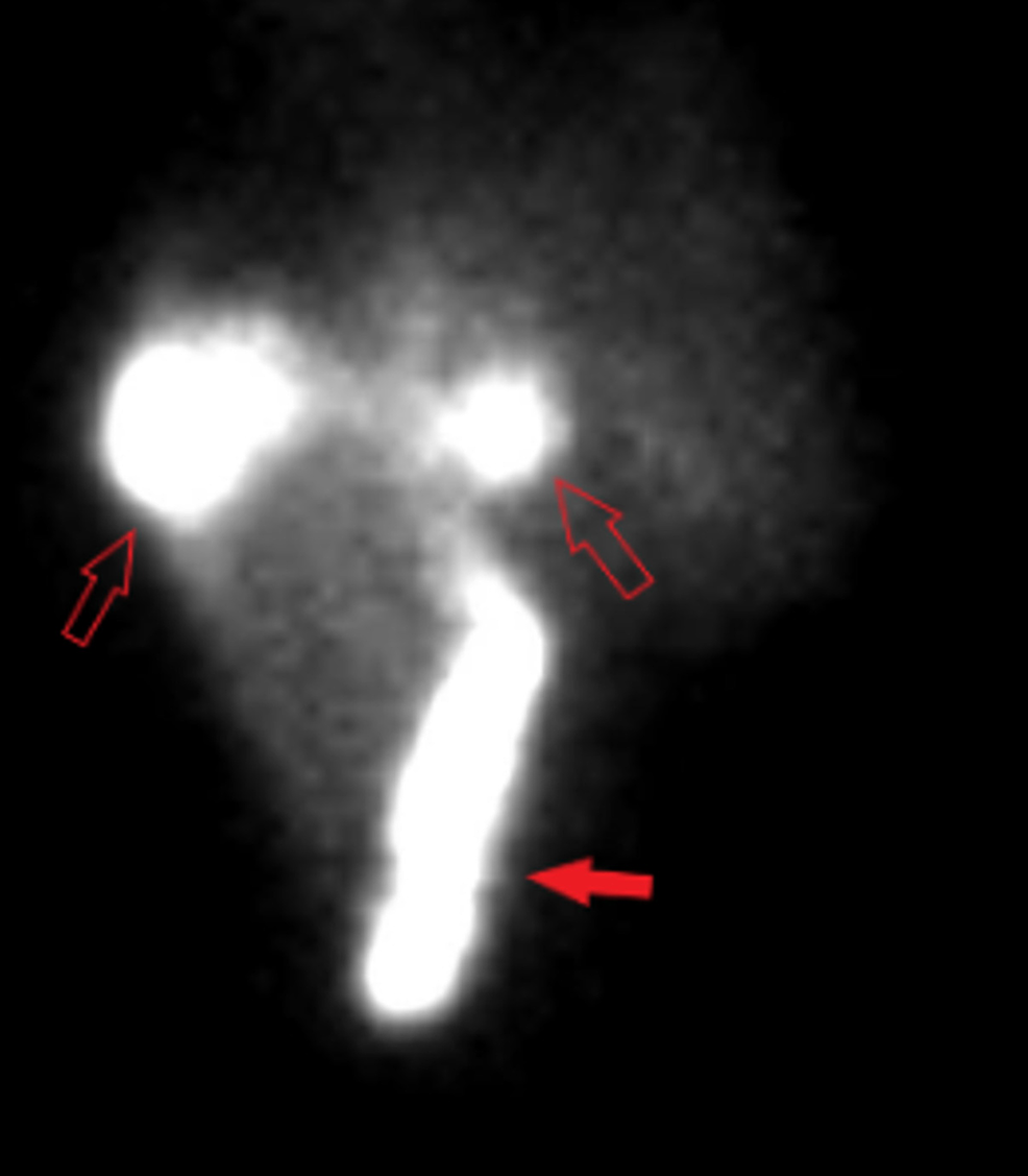 Cureus Spontaneous Bile Leak in a Patient Without Recent Abdominal