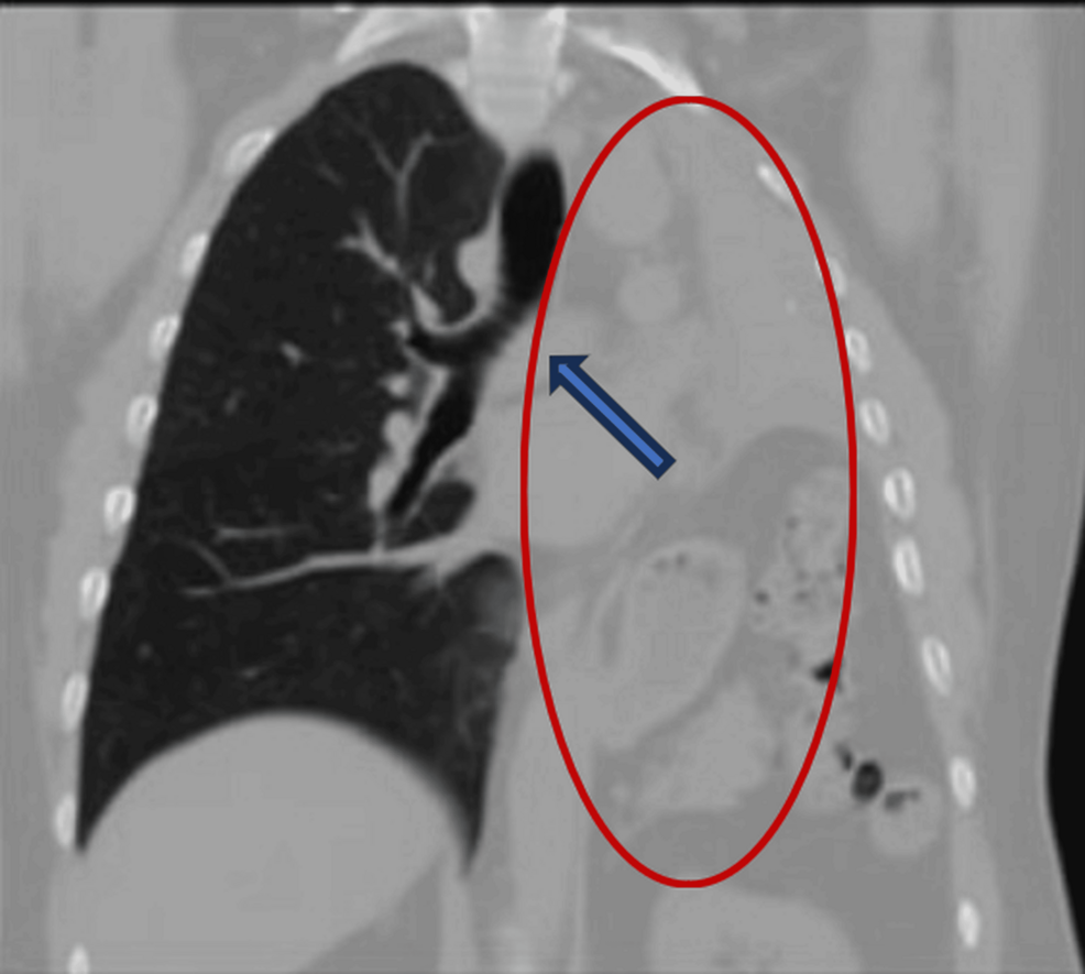Preoperative-coronal-chest-computed-tomography