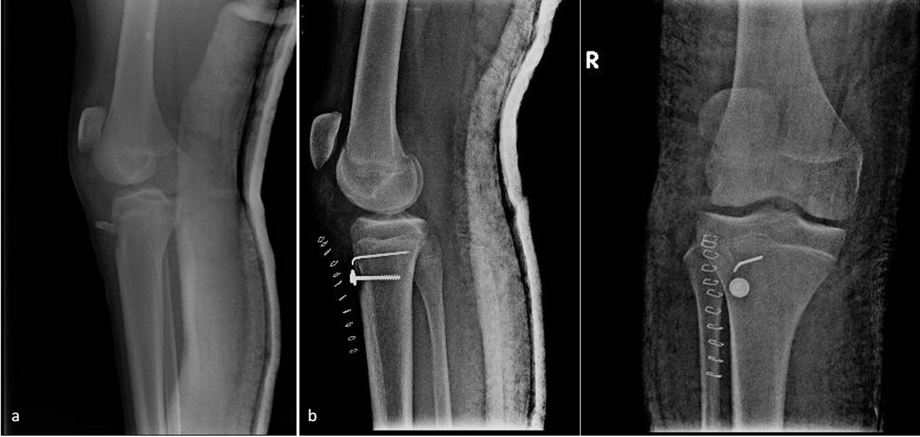 Cureus | Neglected Rupture Of The Patellar Tendon After Fixation Of ...