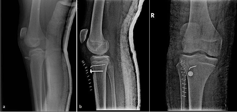 Neglected Rupture Of The Patellar Tendon After Fixation Of Tibial ...