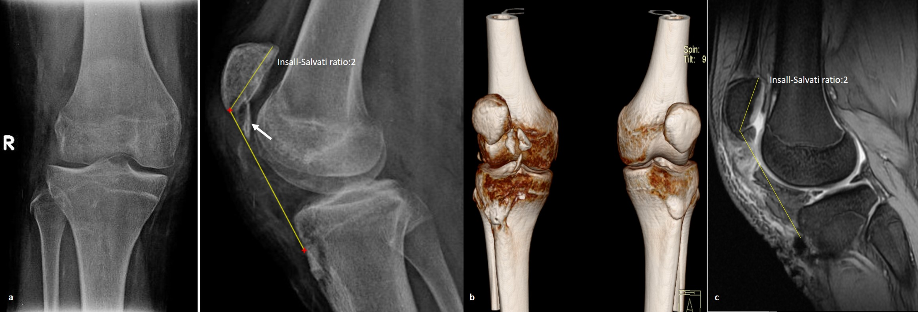 Cureus | Neglected Rupture Of The Patellar Tendon After Fixation Of ...