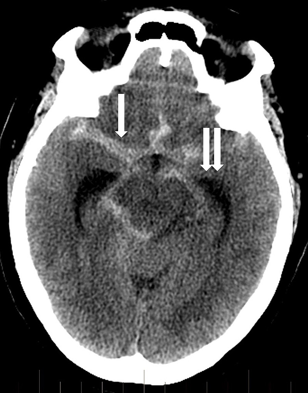 Coil Now, Pipe Later Twostage Treatment for Acute Intracranial