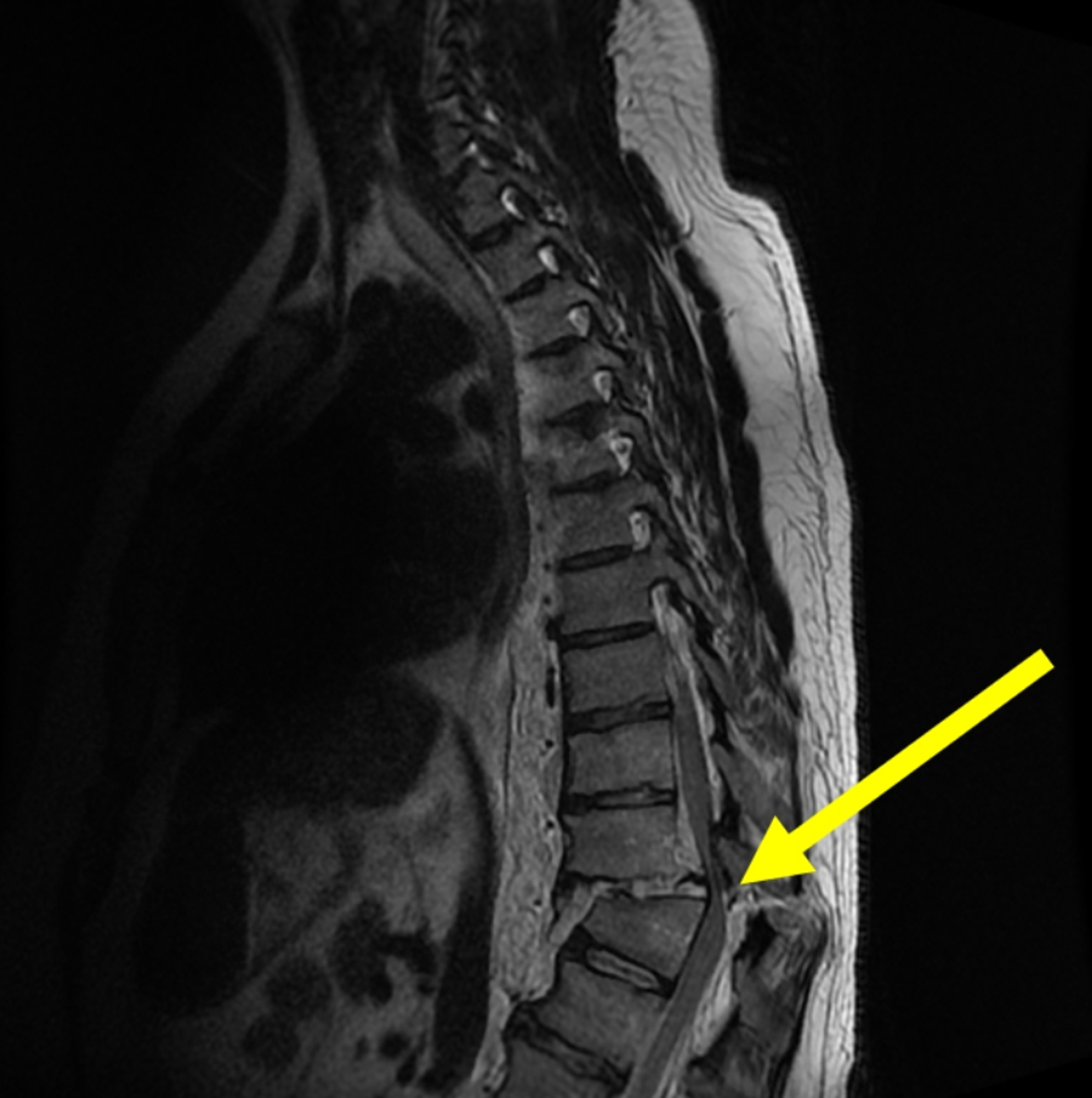 Cureus | Charcot Spinal Arthropathy-Induced Progression From Upper to ...