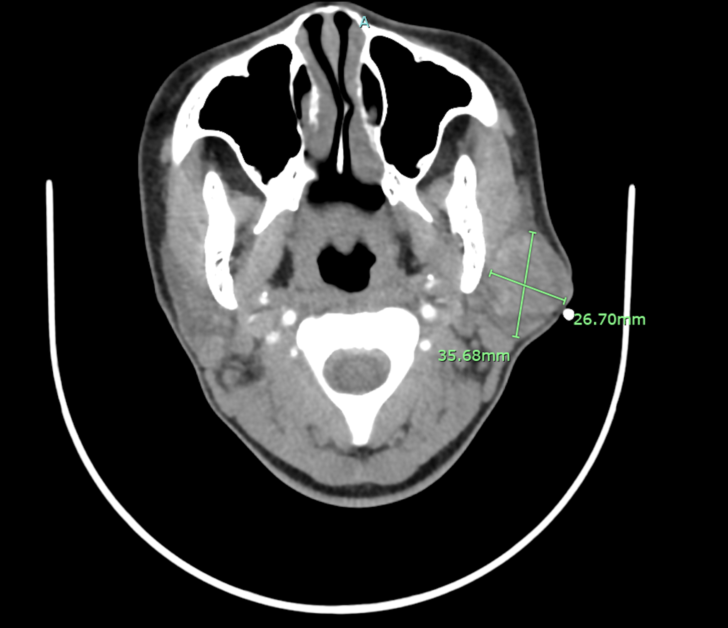 Cureus A Diagnostically Challenging Parotid Gland Tumor With Hybrid Features