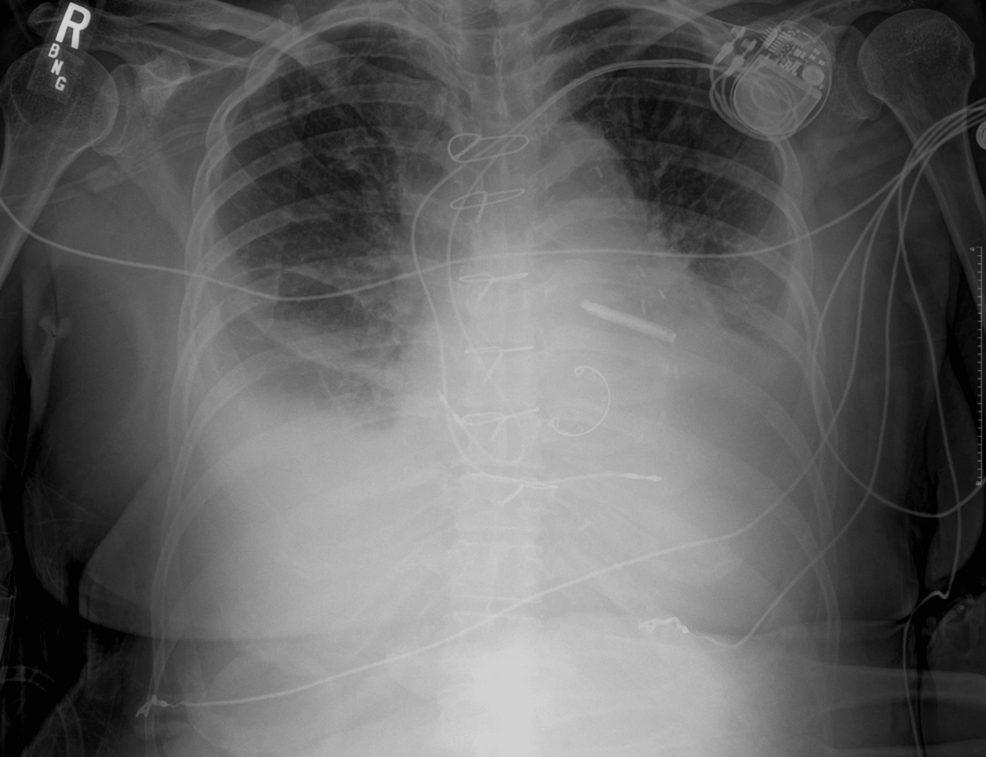 Reexpansion Pulmonary Edema After Thoracentesis: A Case Report