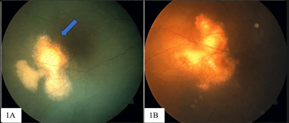 HIV Patient Diagnosed With Presumed Ocular Tuberculosis