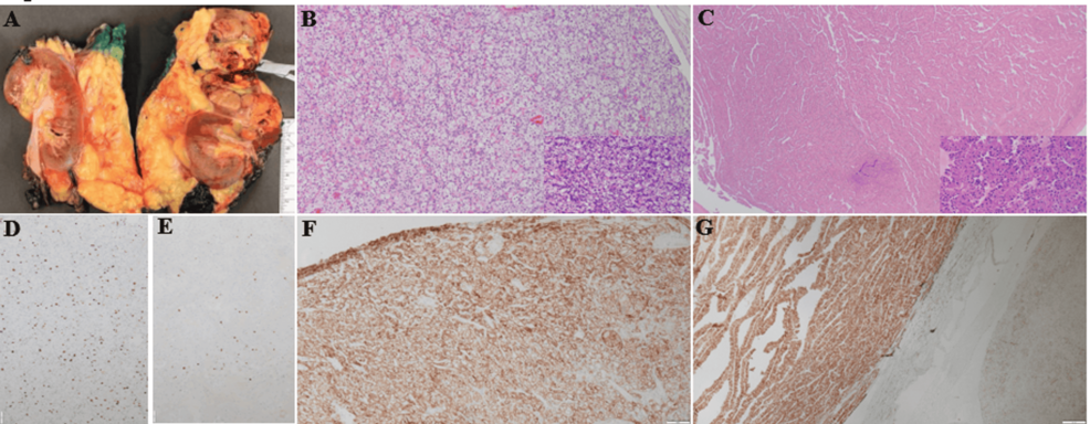Synchronous Clear Cell and Papillary Renal Cell Carcinoma Collision Tumor Confirmed by Component-Specific Next-Generation Sequencing: A Case Report