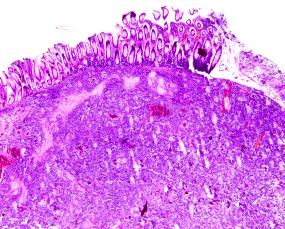 Primary Colonic Diffuse Large B-Cell Lymphoma: Diagnosis and Challenges