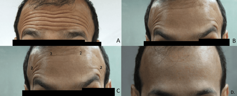 Complications of Botulinum Toxin, Fillers, and Threads: An IADVL Review