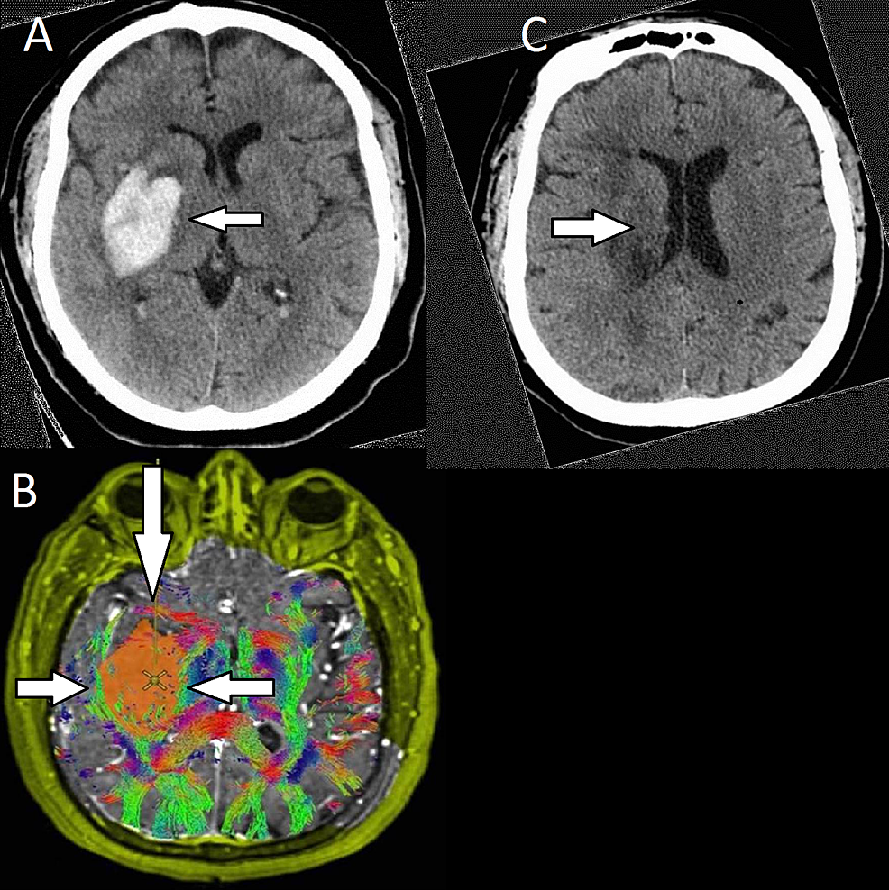 Preoperative-and-postoperative-images-for-patient-three-with-a-basal-ganglia-hemorrhage