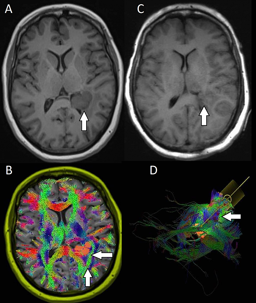 Preoperative-and-postoperative-images-for-patient-four-with-a-left-atrial-meningioma