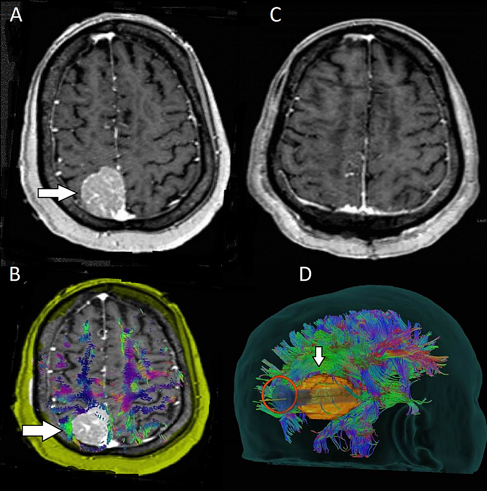 Preoperative-and-postoperative-images-for-patient-six-with-a-posterior-parietal-meningioma