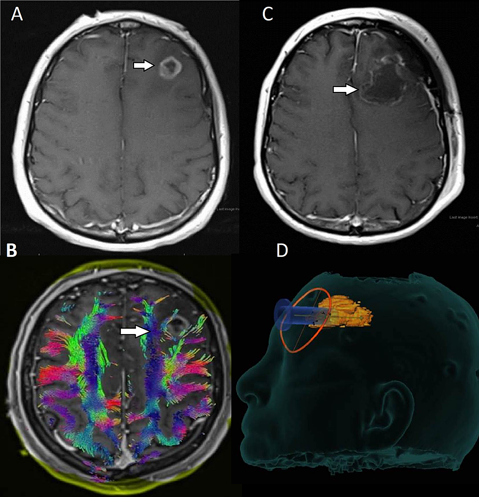 Preoperative-and-postoperative-images-for-patient-seven-with-a-left-frontal-GBM