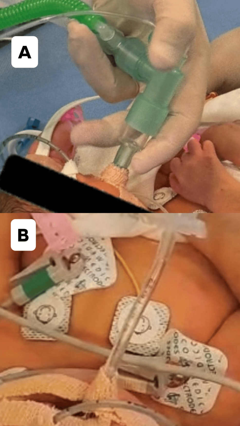 Fiberoptic-guided-tracheal-intubation-through-a-laryngeal-mask-airway-(LMA)-in-a-neonate-with-a-traumatic-difficult-airway.