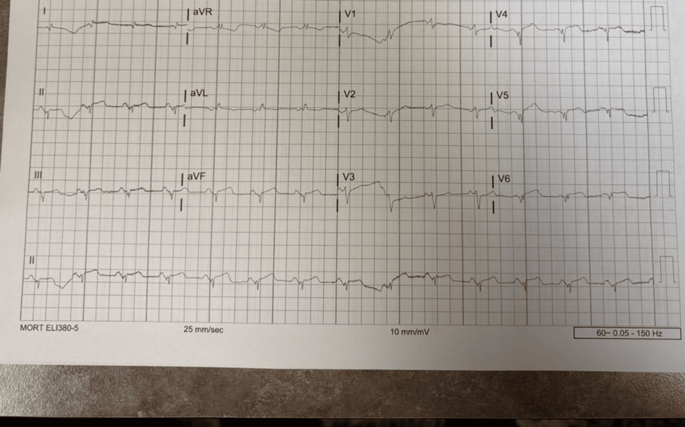 Coronary Embolism: A Rare Complication of Takotsubo Cardiomyopathy