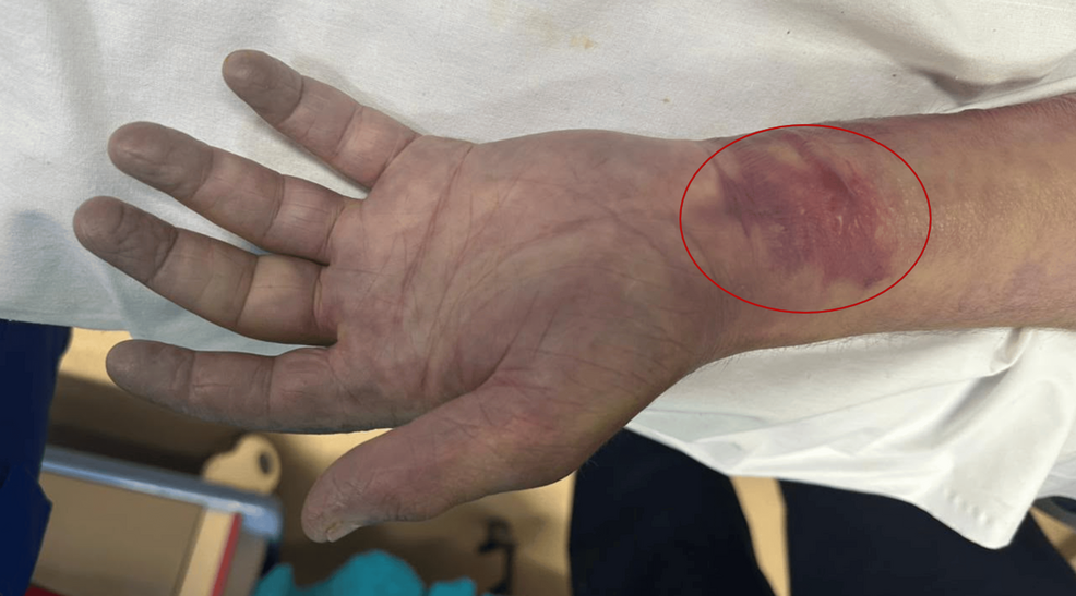 Photo: Cureus Suspected Acute Compartment Syndrome Following Snakebite Envenomation: A Fatal Case Highlighting