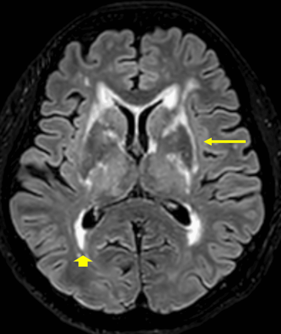 Late-Onset CADASIL Presenting With Migraine and Abnormal MRI: A Case Report