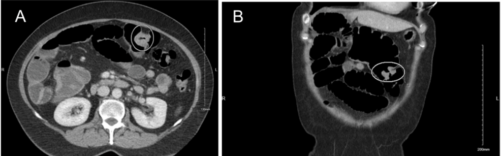 Computed-tomography-(CT)-scan-of-the-abdomen-and-pelvis
