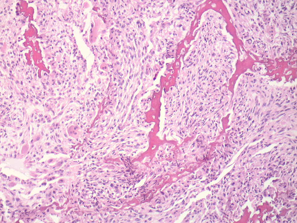 Cureus | A Rare Primary Osteogenic Sarcoma of the Prostate and Bladder