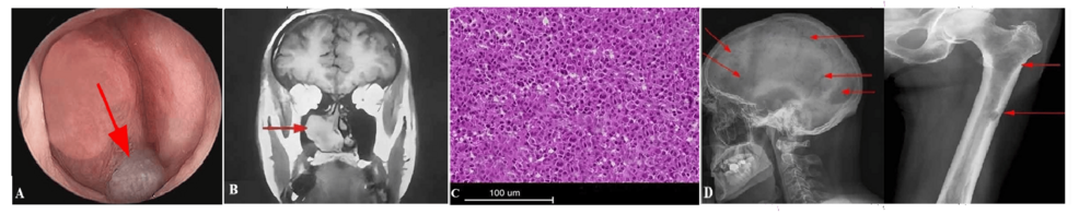 Recurrent Epistaxis as a Rare Presentation of Extramedullary Multiple Myeloma