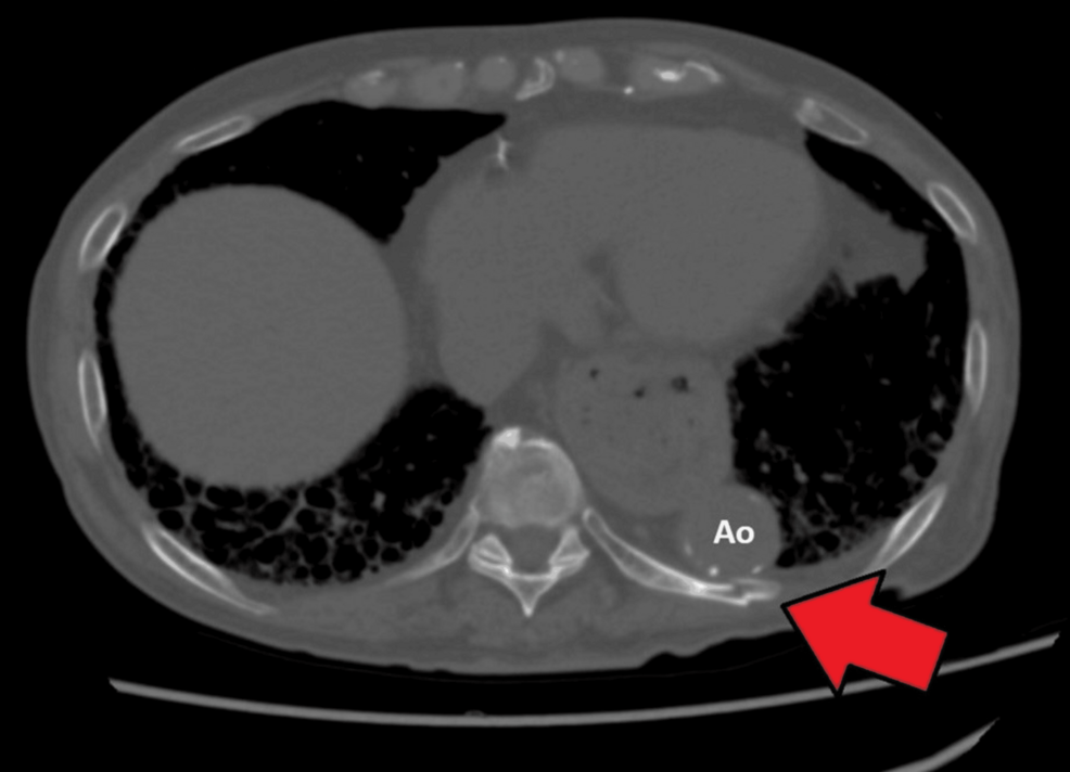 Delayed Traumatic Aortic Injury from Rib Fracture: Case Report