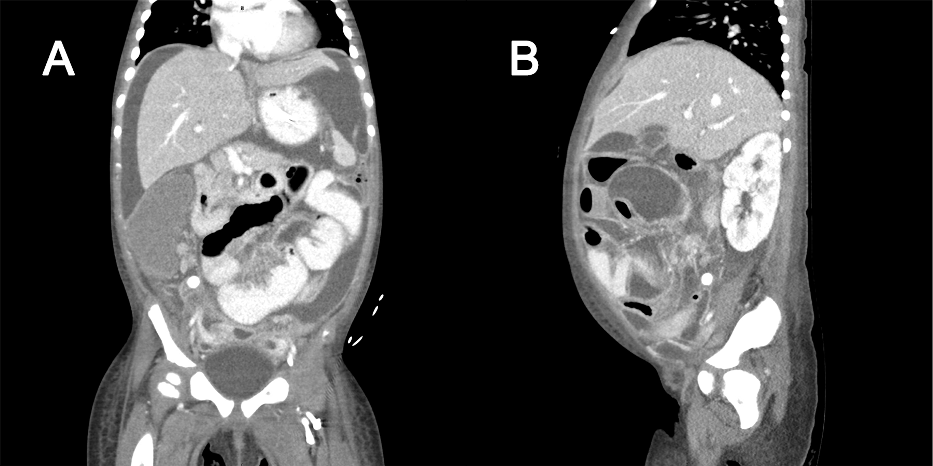 Cureus Acute Appendicitis Associated With Multisystem Inflammatory Syndrome In Children