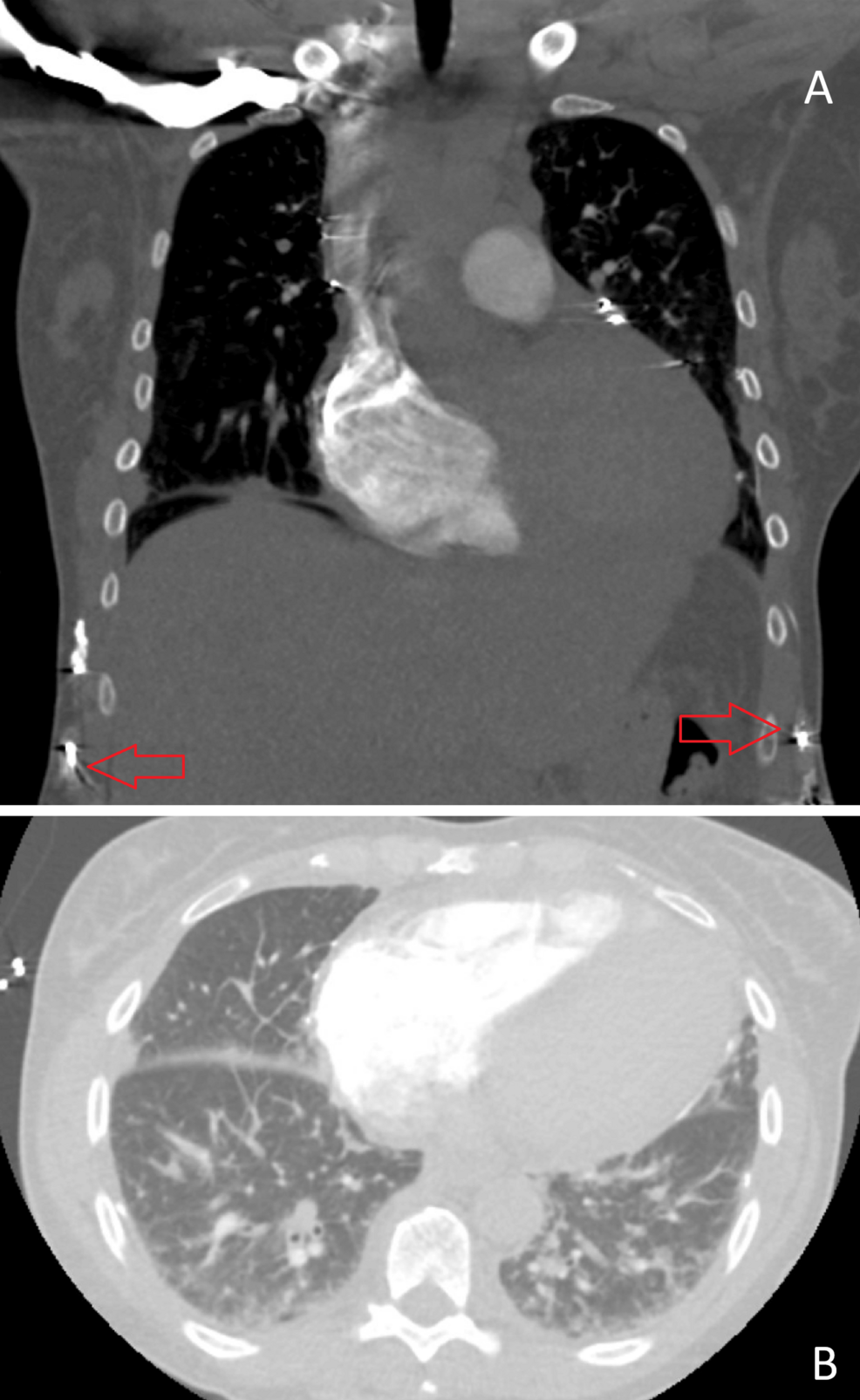Computed-tomography-angiography-(CTA)-of-the-chest