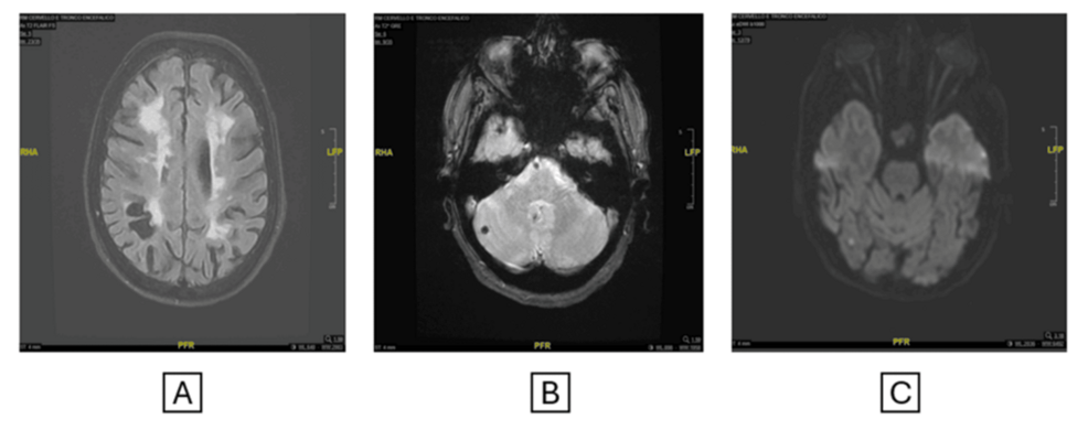 Late-Onset Antiphospholipid Syndrome Presenting With Recurrent Multifocal Ischemic Strokes: Diagnostic and Management Challenges