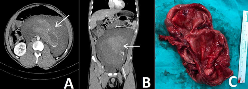 Sudden onset flank pain: a case report of retroperitoneal hemorrhage s