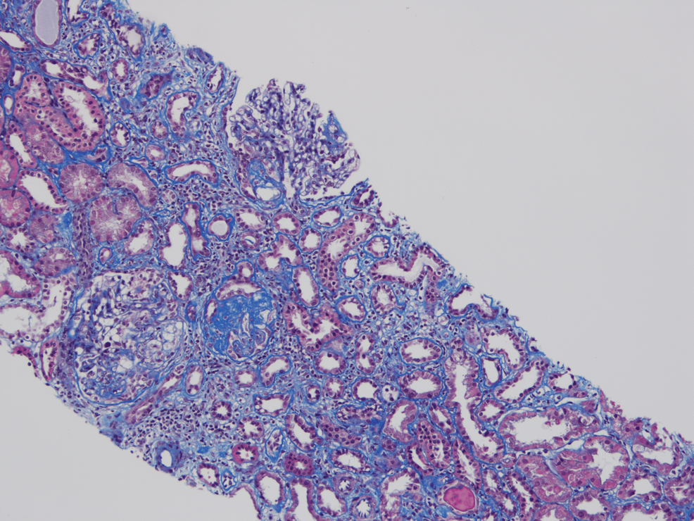 Light-photomicrograph-of-the-renal-biopsy-showing-mesangioproliferative-glomerulonephritis-with-increased-mesangial-cellulari