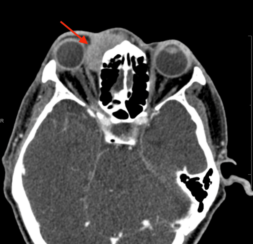 Rare Epstein-Barr Virus-Positive Carcinoma Discovered in Medial Orbit