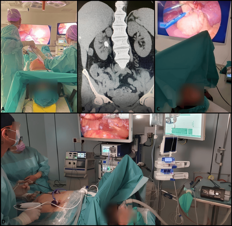 Thoracic Segmental Spinal Anesthesia: A Safer Alternative for High-Risk Spine Surgery - News Directory 3