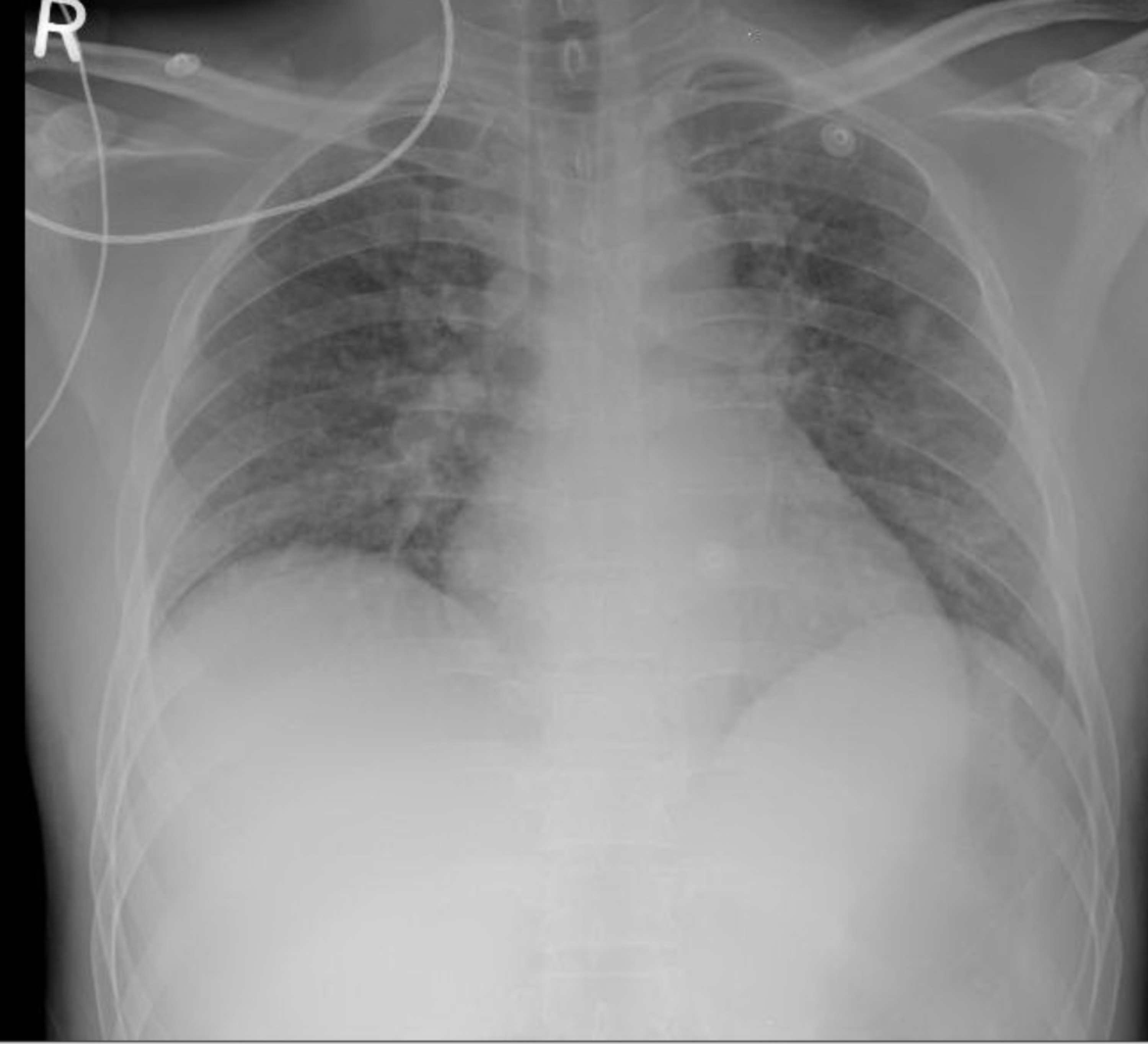 Cureus | Invasive Klebsiella pneumoniae Syndrome in Qatar: A Case Report