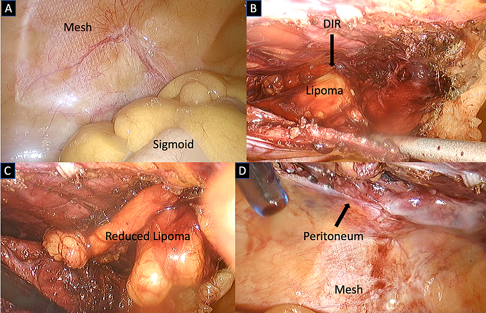 A) The left inguinal hernia sac is opened, revealing a sliding sigmoid