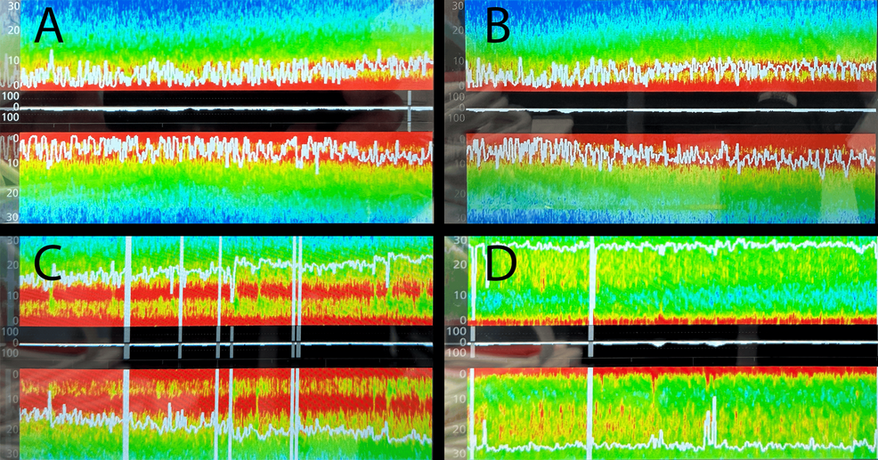 Representative-SedLine®-display-across-defined-stages-of-the-case-(A:-maintenance-and-normothermia;-B:-hypothermic-CPB-nadir;-C:-start-of-emergence;-D:-after-extubation),-showing-the-SEF95-(white-line)-and-DSA-bilaterally.-In-each-panel,-the-left-hemisphere-DSA-is-displayed-above-the-center-and-the-right-hemisphere-DSA-below-it,-as-mirror-images,-with-frequency-(0-30-Hz)-increasing-away-from-the-center-line,-time-on-the-horizontal-axis,-and-EEG-power-indicated-by-color-(warm-colors,-higher-power;-cool-colors,-lower-power). 