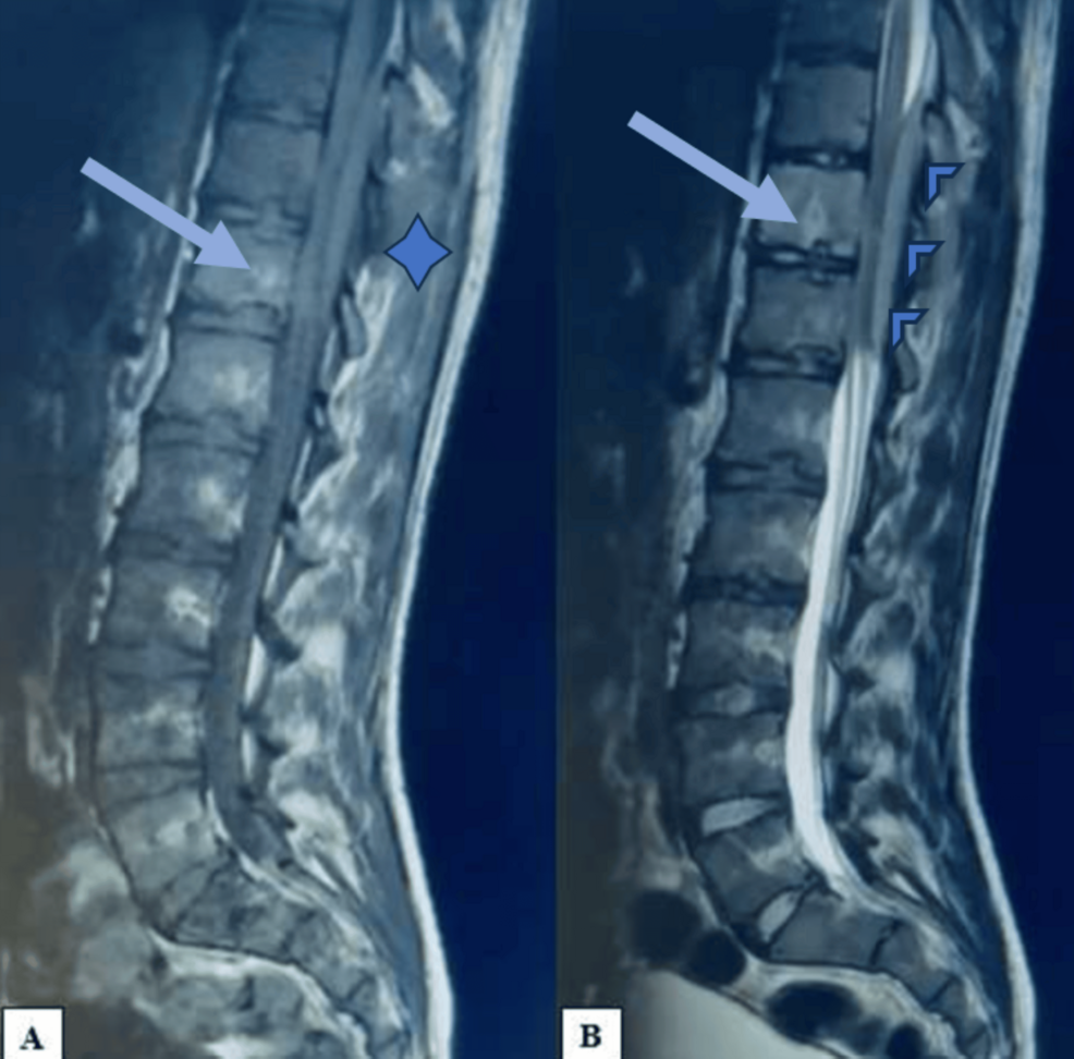 Spinal Cord Compression Syndrome Revealing Thoracic Ewing Sarcoma in a Young Adult: A Case Report - Cureus