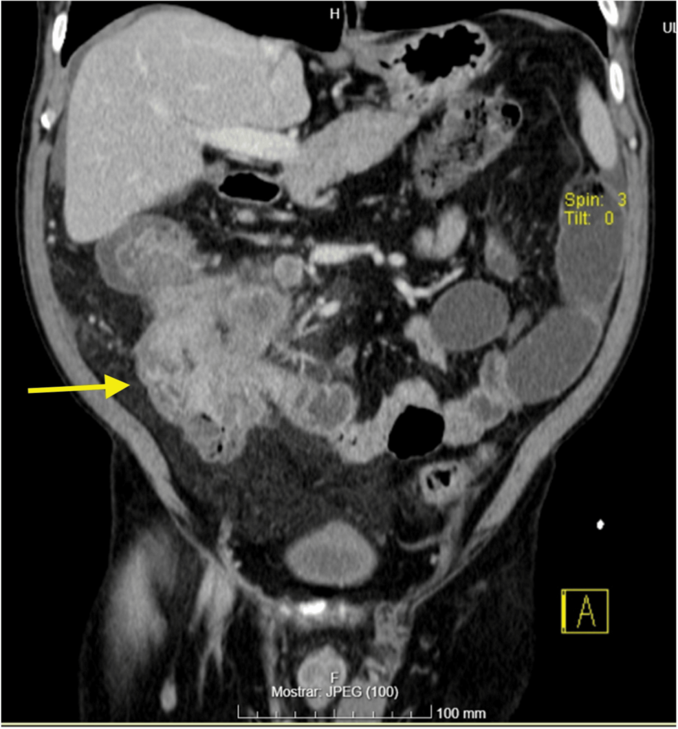 Perforated Large-Cell Neuroendocrine Carcinoma of the Colon: A Case Report
