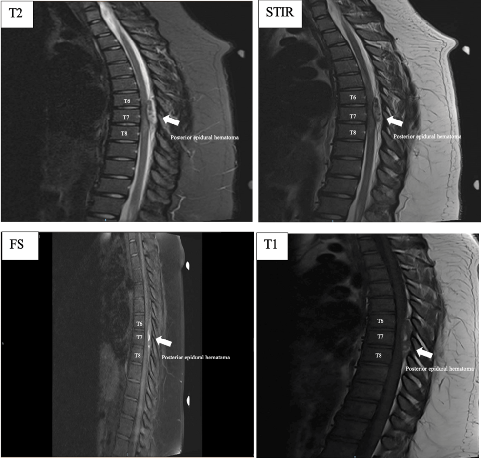 Thoracic Spontaneous Spinal Epidural Hematoma in a Young Adult: A Case Report