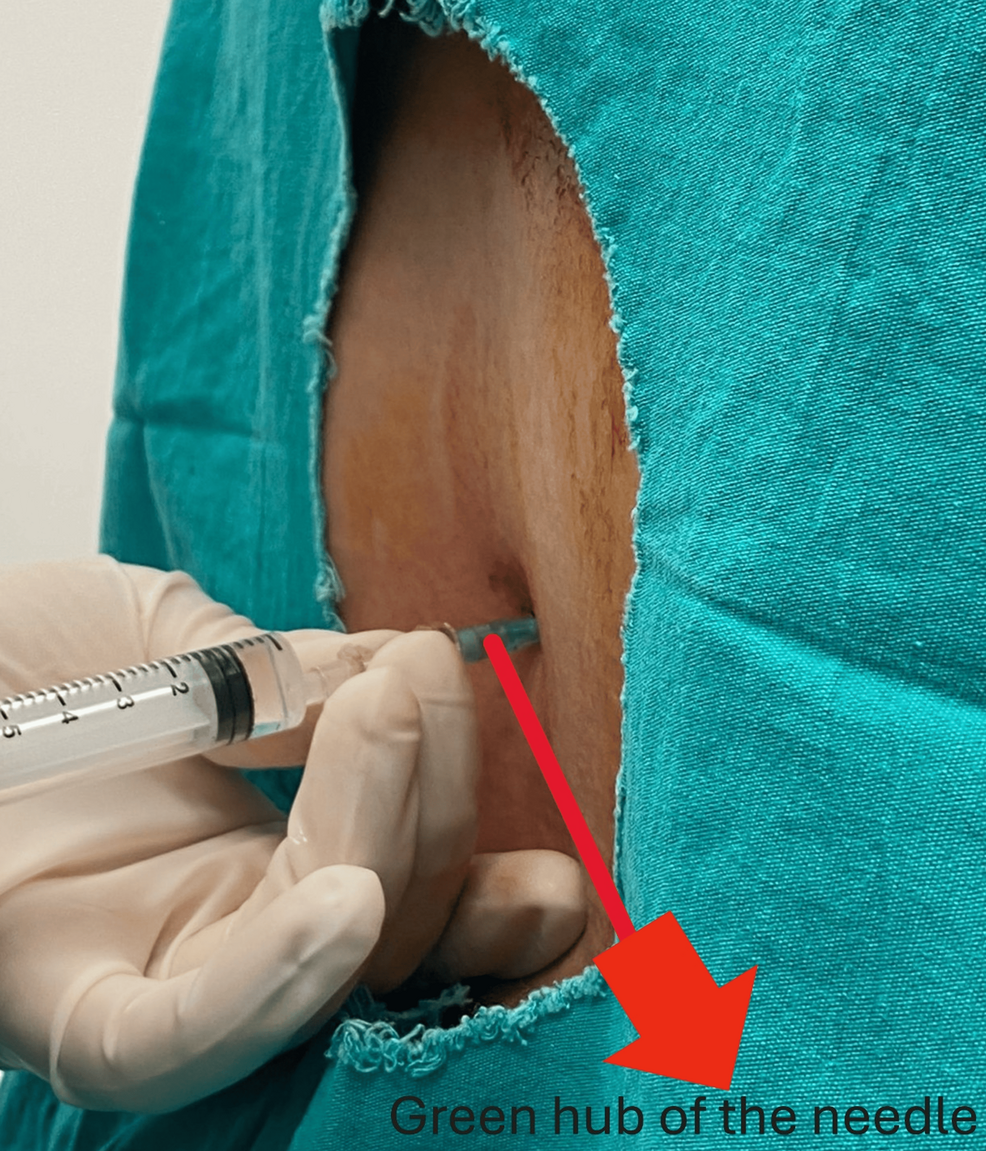 Clinical-application-of-the-modified-introducer-technique-during-spinal-anesthesia.